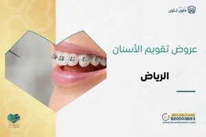 عروض تقويم الأسنان الرياض
