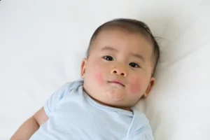 علاج أكزيما الوجه للرضع 
