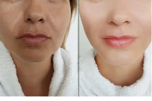 فراكشنال ليزر للوجة قبل وبعد