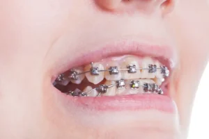 كيف أعرف أن التقويم انكسر؟