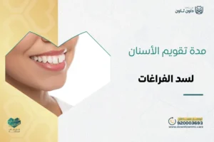 مدة تقويم الأسنان لسد الفراغات