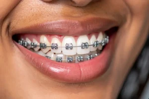 هل التقويم يضعف الأسنان