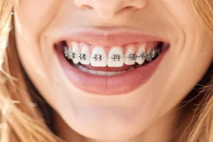 هل التقويم يعدل الفك العلوي