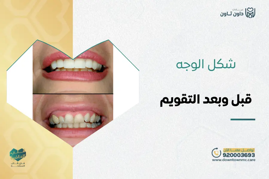 هل يتغير شكل الوجه قبل وبعد التقويم