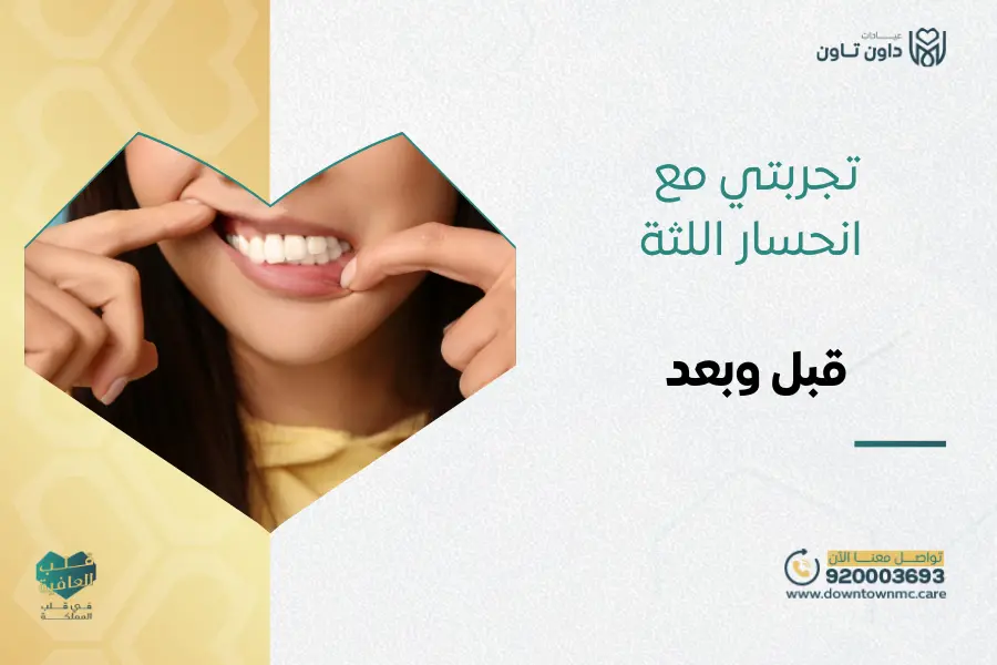 تجربتي مع انحسار اللثة قبل وبعد في داون تاون السعودية