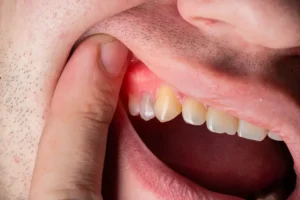 علاج التهاب اللثة الشديد في المنزل 