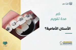 كم مدة تقويم الأسنان الأمامية
