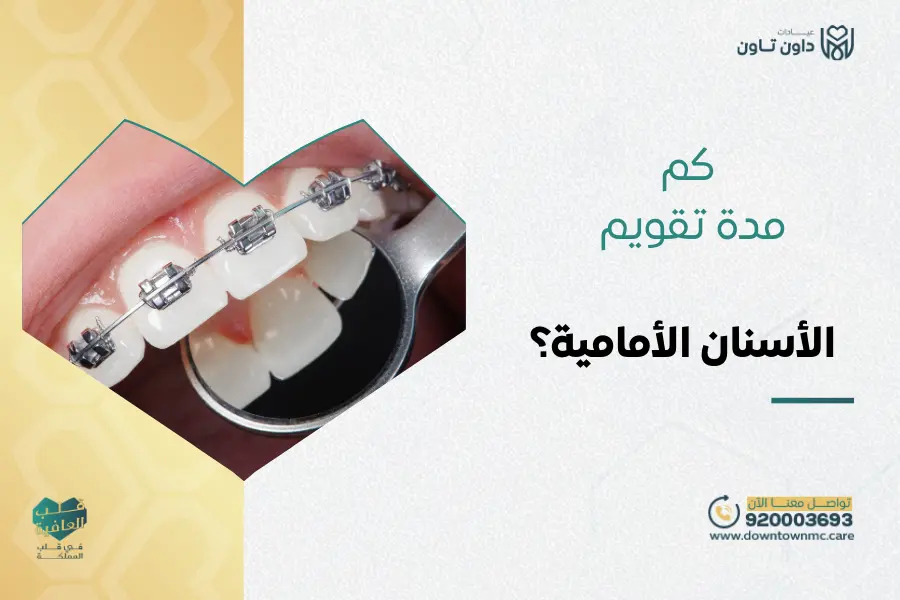 كم مدة تقويم الأسنان الأمامية