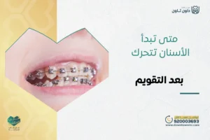 متى تبدأ الأسنان تتحرك بعد التقويم؟