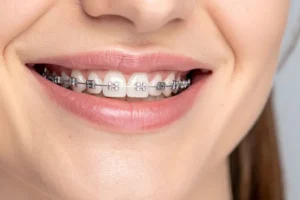 مدة تقويم الأسنان الأمامية