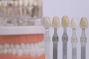 تجربتي مع عدسات الأسنان بدون نحت في داون تاون