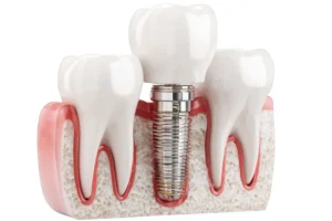 مميزات زراعة الأسنان الفورية في السعودية