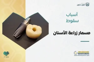 أسباب سقوط مسمار زراعة الأسنان وأفضل الحلول والنصائح