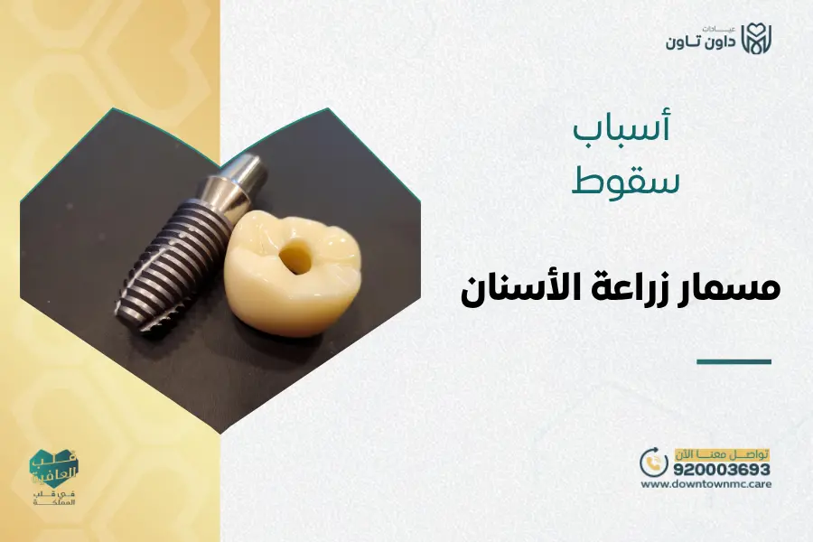 أسباب سقوط مسمار زراعة الأسنان وأفضل الحلول والنصائح