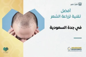 أفضل تقنية لزراعة الشعر في جدة السعودية