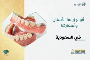 أنواع زراعة الأسنان وأسعارها في السعودية