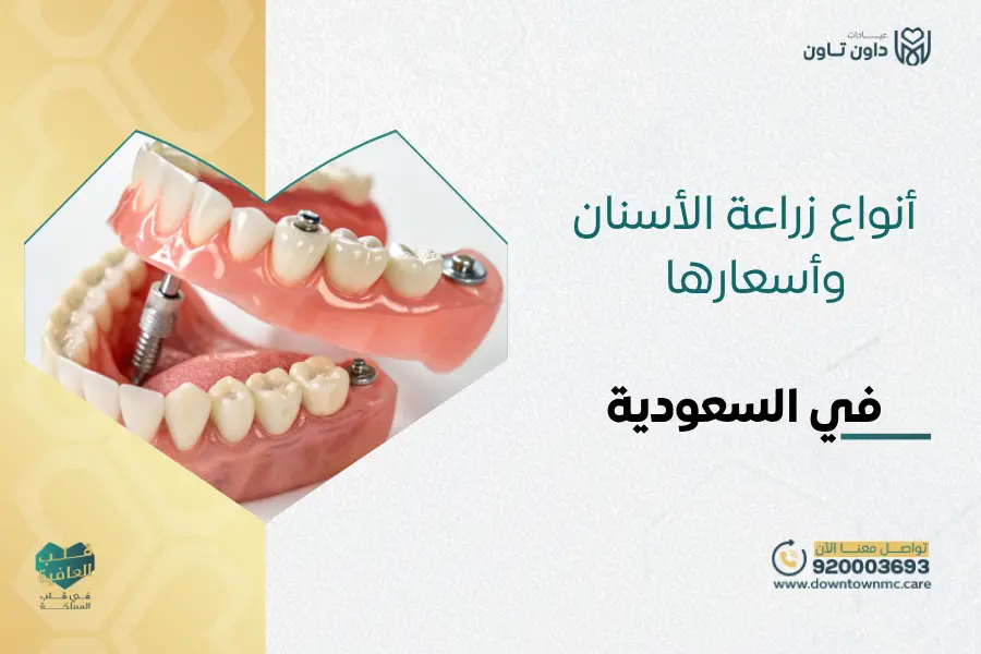 أنواع زراعة الأسنان وأسعارها في السعودية