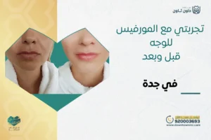 تجربتي مع المورفيس للوجه قبل وبعد في جدة