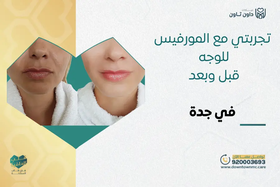 تجربتي مع المورفيس للوجه قبل وبعد في جدة
