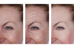 تجربتي مع جهاز الترافورمر قبل وبعد