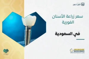 سعر زراعة الأسنان الفورية في السعودية 2026