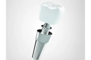 شكل مسمار زراعة الاسنان مكونات زراعة الأسنان