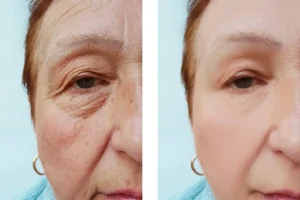 فوائد وأضرار إبرة Versus إبرة فيرسيس قبل وبعد