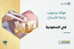 فوائد وعيوب زراعة الأسنان الفورية والتقليدية في السعودية