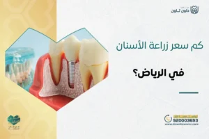 كم سعر زراعة الأسنان في الرياض