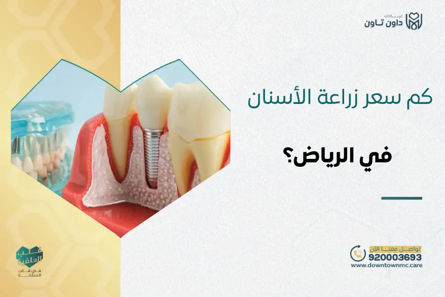 كم سعر زراعة الأسنان في الرياض