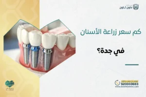 كم سعر زراعة الأسنان في جدة