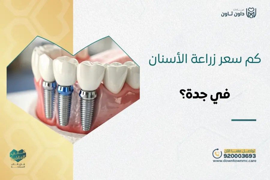 كم سعر زراعة الأسنان في جدة