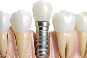 ما هو أفضل سعر لزراعة الأسنان في الرياض