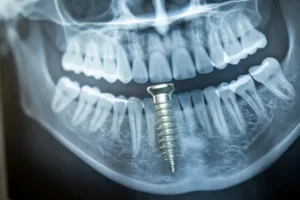 ما هو سعر زراعة الأسنان الفورية؟