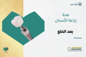 مدة زراعة الأسنان بعد الخلع