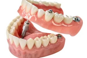 مدة زراعة الأسنان بعد الخلع للزرع الفوري 