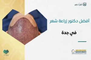 أفضل دكتور زراعة شعر في جدة