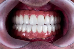 أنواع الحشوات التجميلية مميزات الحشوات التجميلية