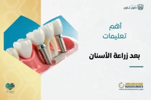 أهم تعليمات بعد زراعة الأسنان: دليل التعافي السريع