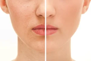 بيكو ليزر قبل وبعد ليزر بيكو لتفتيح الشفايف