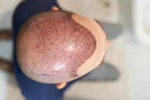 زراعة الشعر في جدة بكم 