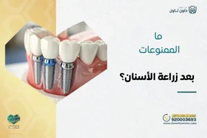 ما الممنوعات بعد زراعة الأسنان؟ 8 تعليمات هامة