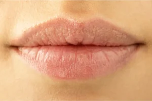 مميزات ليزر بيكو لتفتيح الشفايف وأضرار جلسة بيكو للشفايف