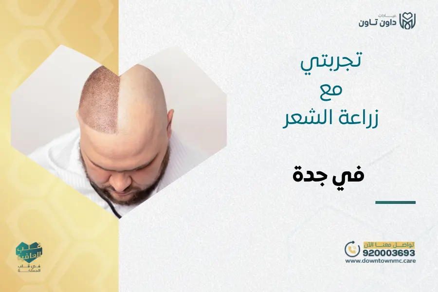 تجربتي مع زراعة الشعر في جدة