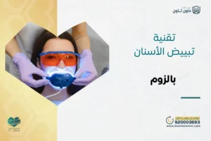 تقنية تبييض الأسنان بالزوم: المزايا والعيوب والخطوات