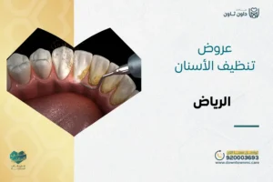 عروض تنظيف الأسنان الرياض 2026
