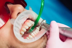 عروض تنظيف الأسنان بالرياض