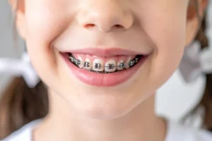 فوائد تقويم الأسنان للأطفال قبل وبعد