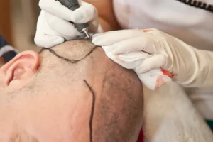 عيادات زراعة الشعر في جدة
تكلفة زراعة الشعر بالسعودية
عروض زراعة الشعر في جدة