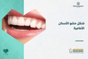شكل حشو الأسنان الأمامية